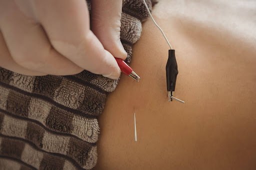 acupuncture for fertility in miami
