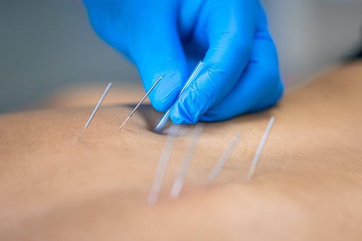 acupuncture for fertility in miami