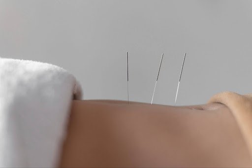 reproductive acupuncture in miami
