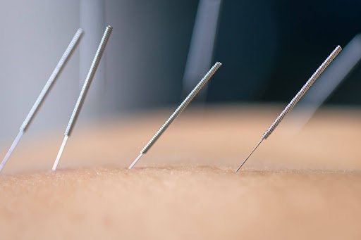 reproductive acupuncture in miami